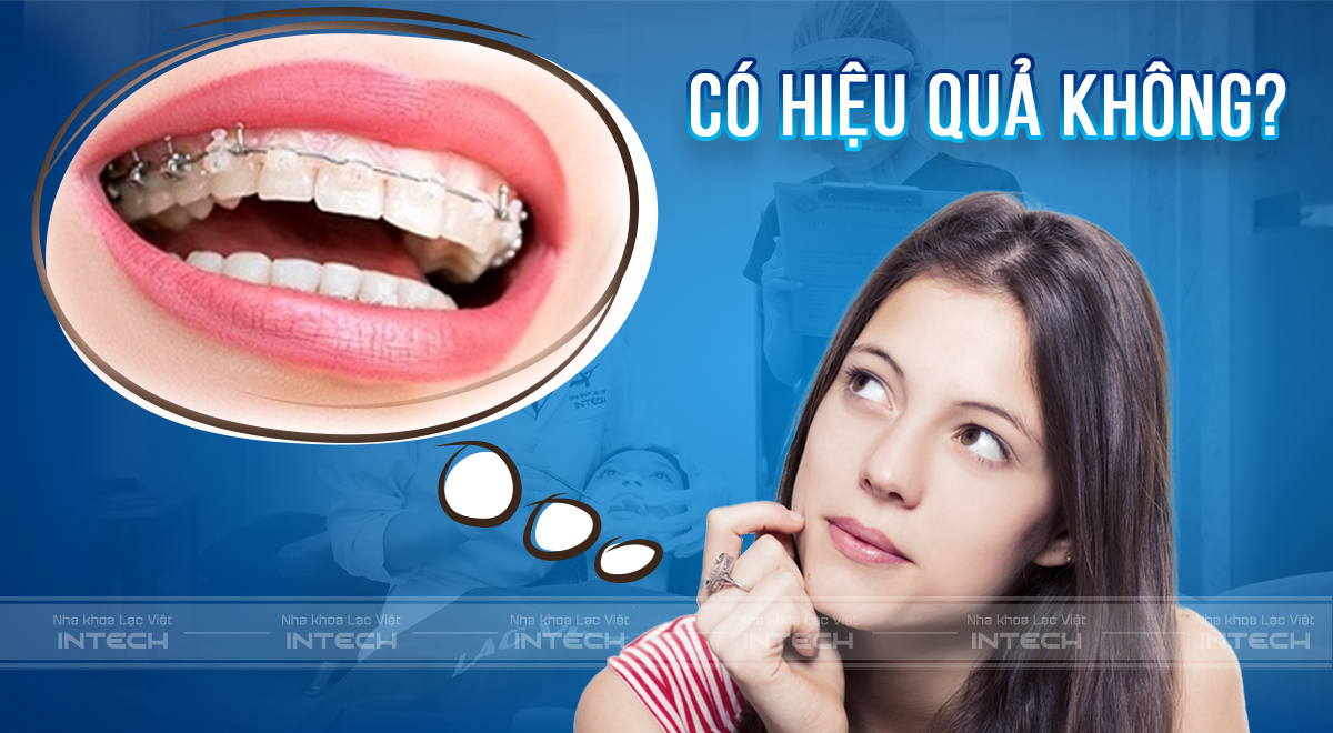 niềng răng bao nhiêu tiền một hàm