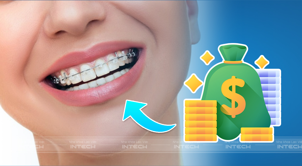 niềng răng hàm trên giá bao nhiêu
