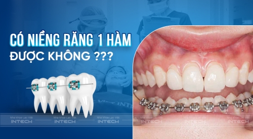 Niềng răng 1 hàm có được không? Giá bao nhiêu tiền?