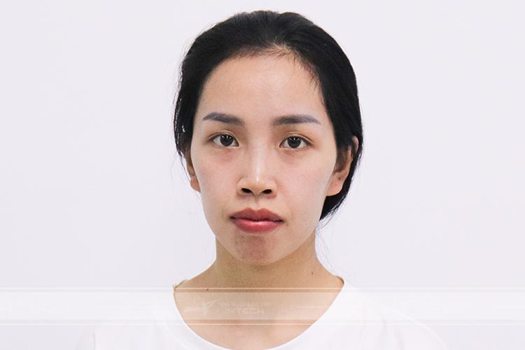 Niềng răng sai kỹ thuật gây hóp má