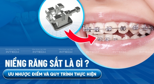 Niềng răng sắt là gì? Ưu nhược điểm và quy trình thực hiện