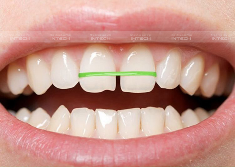 cách niềng răng tại nhà
