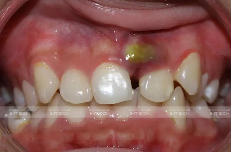 tự niềng răng tại nhà