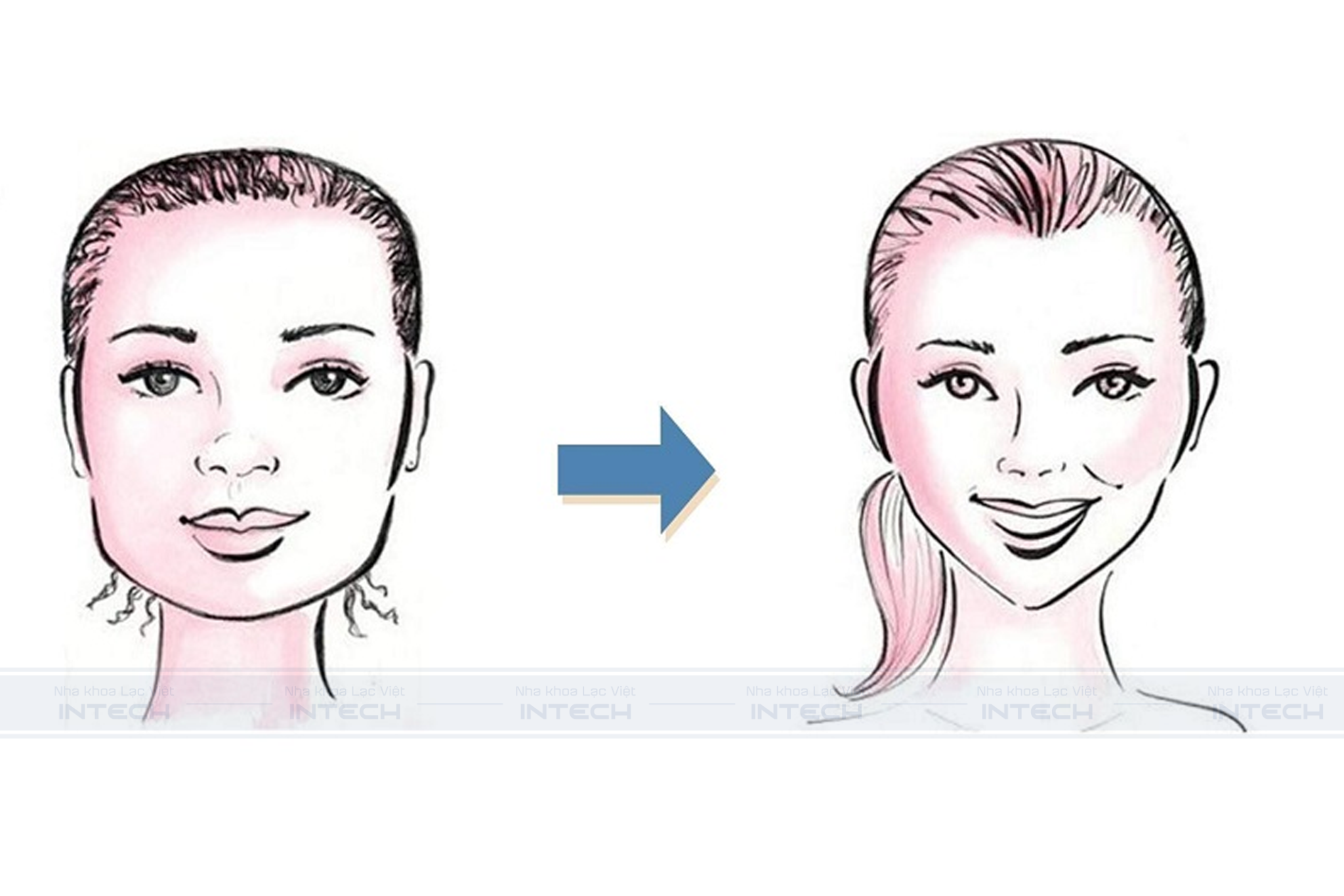 Niềng răng tạo cằm Vline