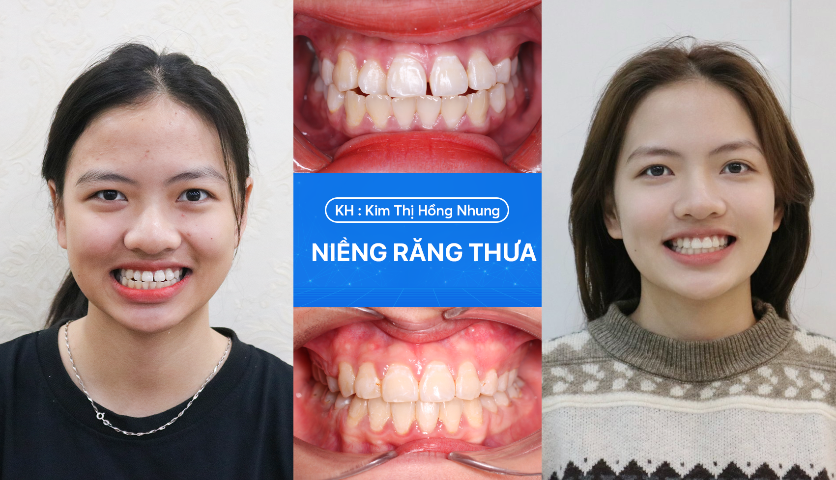 ẳng thưa thay đổi khi niềng răng 