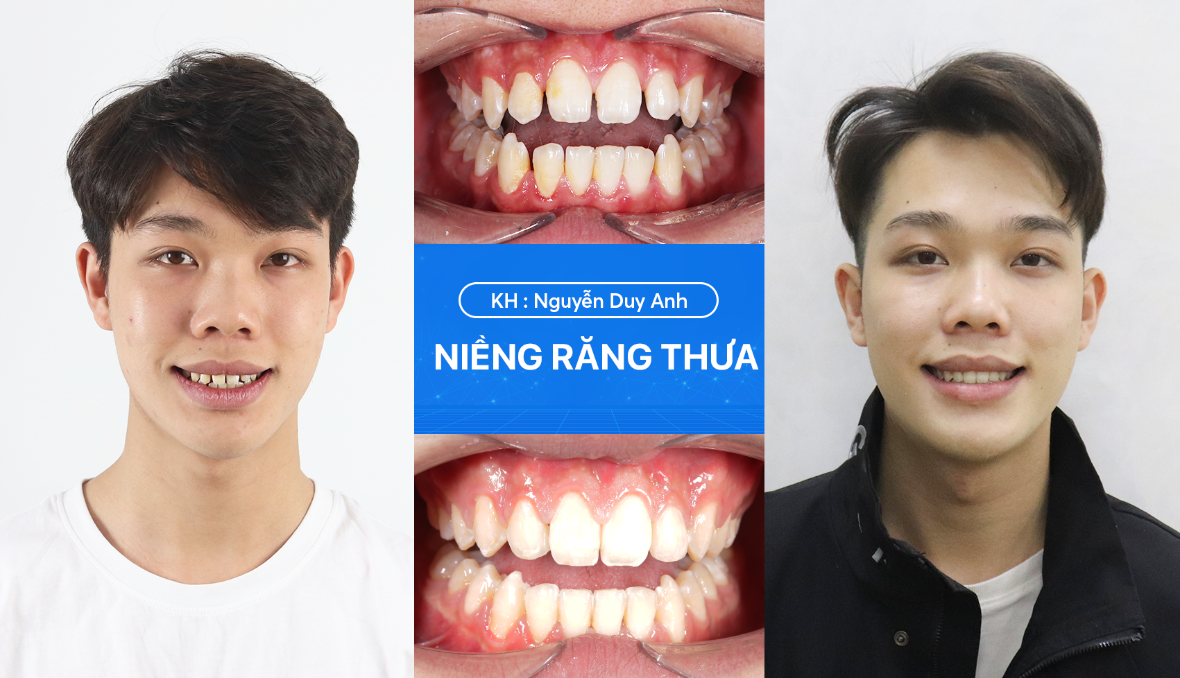 Niềng răng thưa 