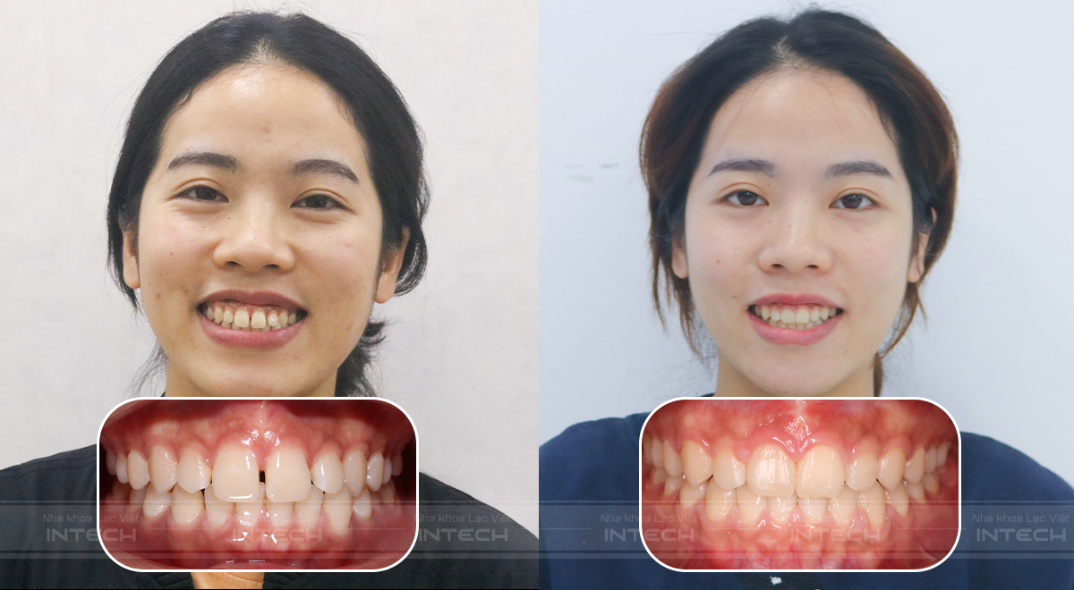 niềng răng thưa có lâu không