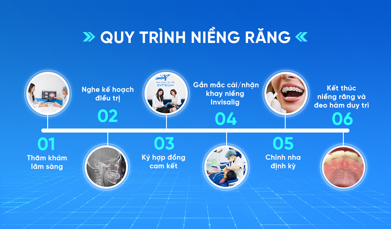 quá trình niềng răng thưa