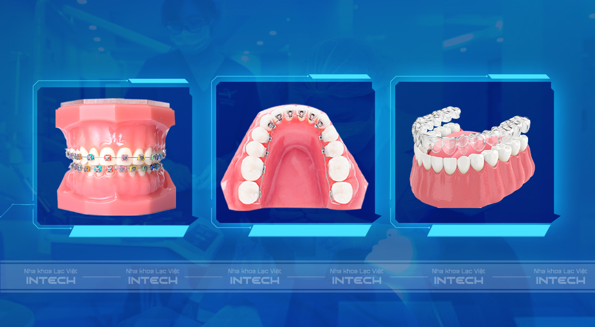 bảng giá niềng răng trả góp
