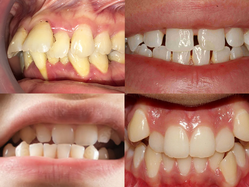 có nên niềng răng cho trẻ em không
