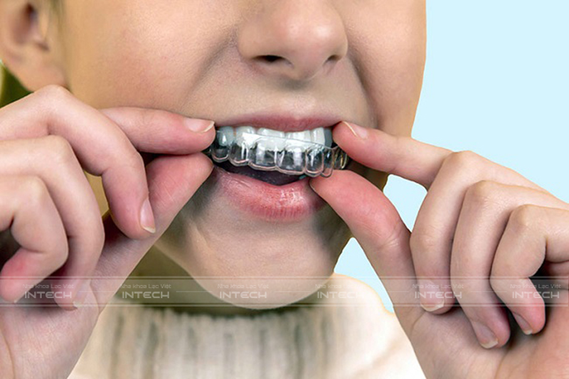 niềng răng trong suốt cho trẻ em