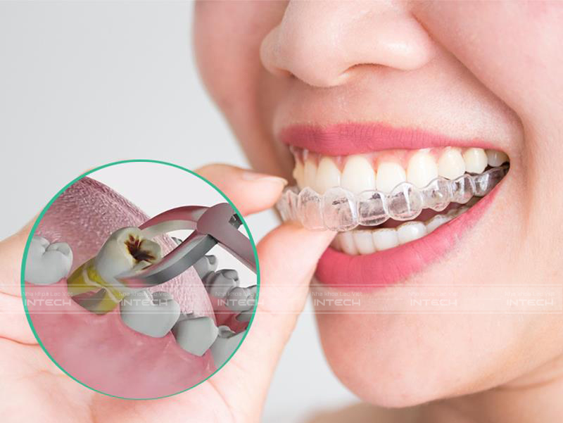 các loại niềng răng trong suốt