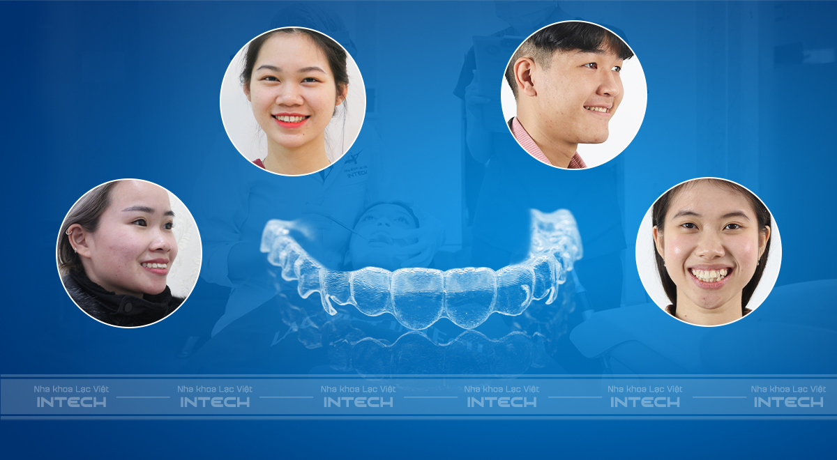 khay niềng răng trong suốt