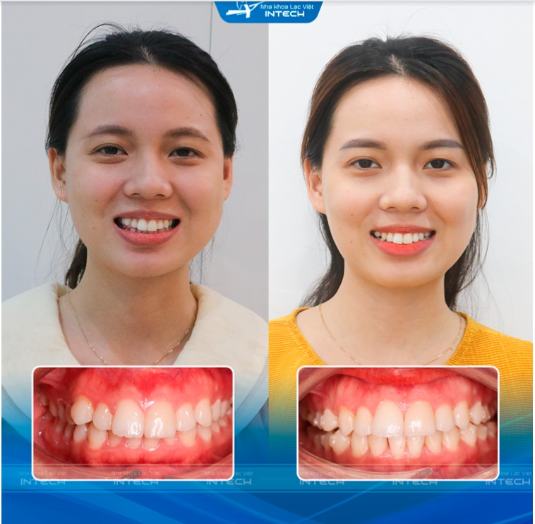 niềng răng trong suốt có hiệu quả không