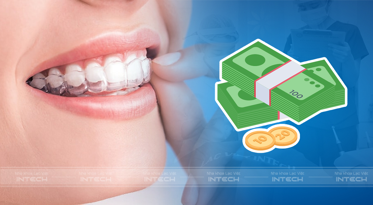 Niềng răng trong suốt giá bao nhiêu
