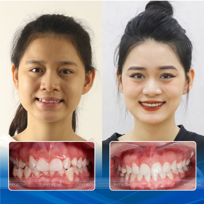 hình ảnh niềng răng