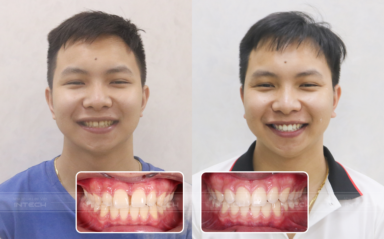 hình ảnh răng vẩu