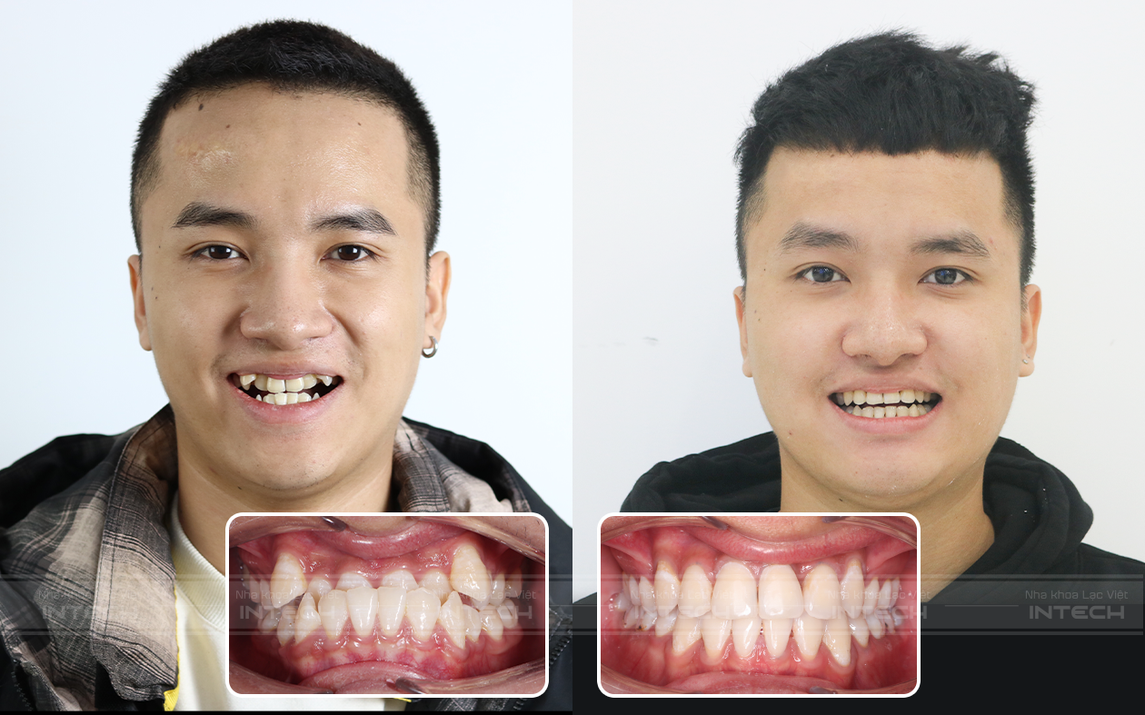niềng răng đẹp
