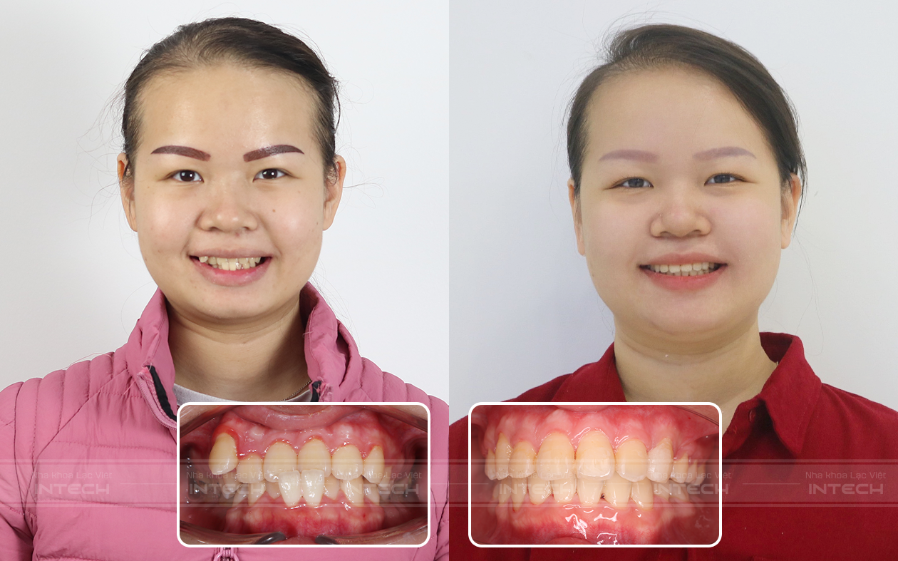 niềng răng hô trước và sau