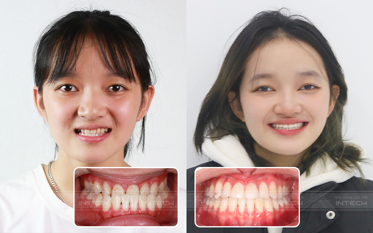 sau khi niềng răng