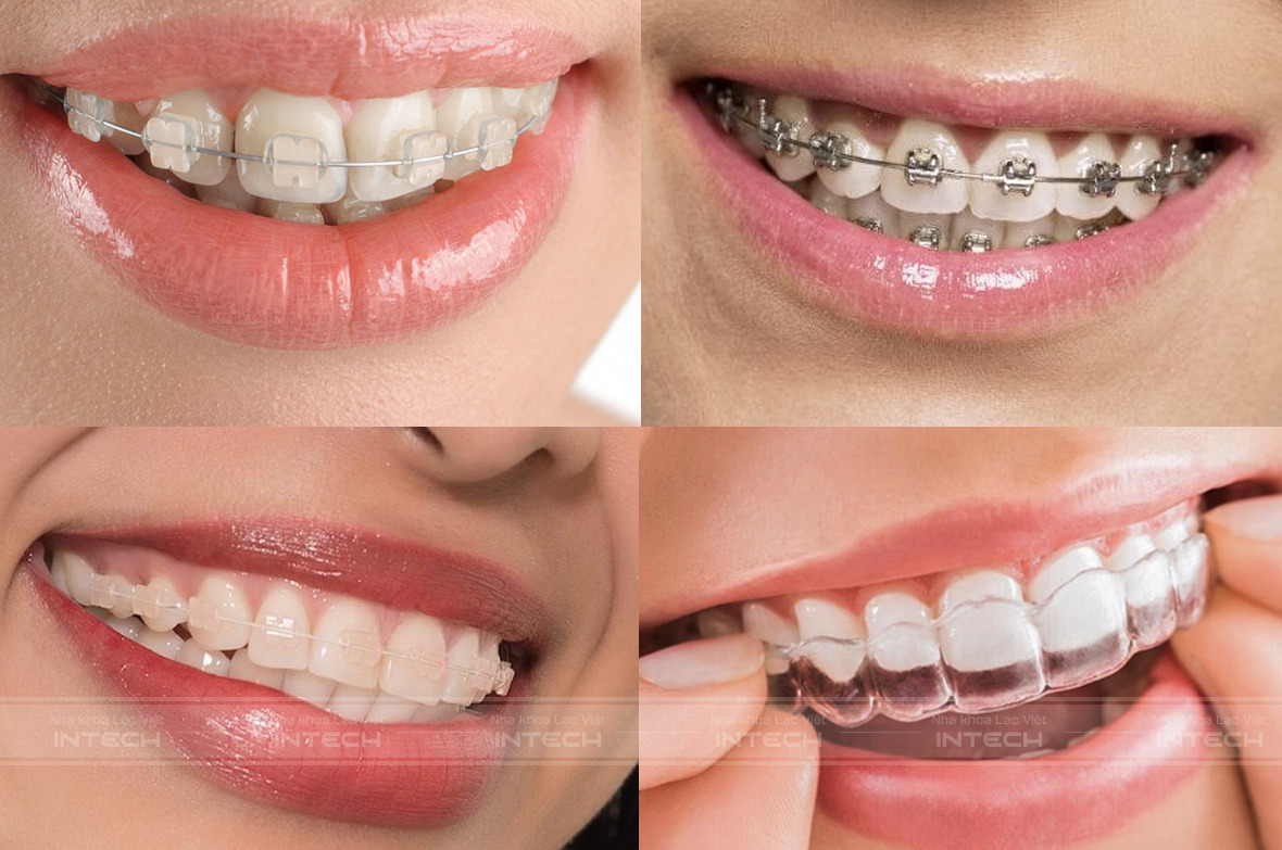 Các phương pháp niềng răng