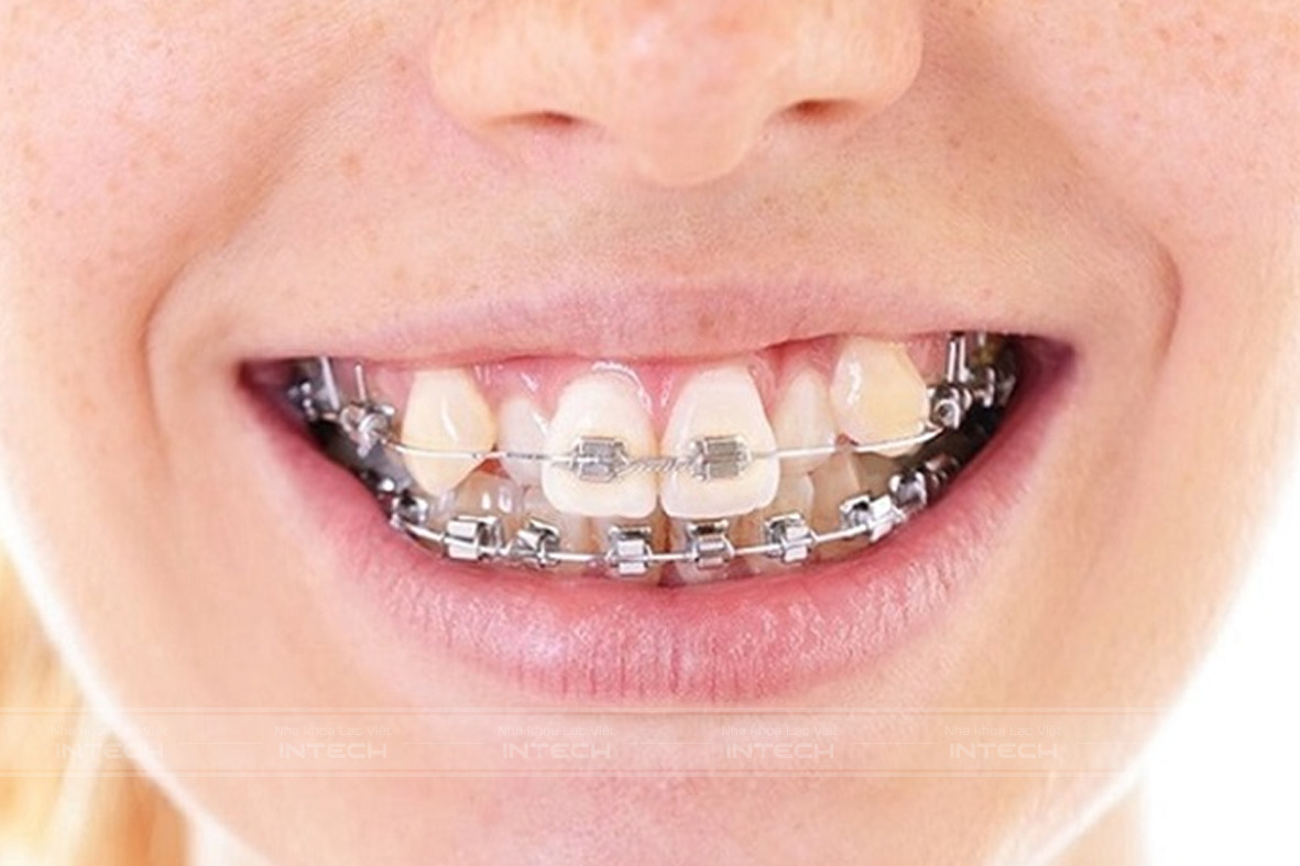 Răng như thế nào thì nên niềng