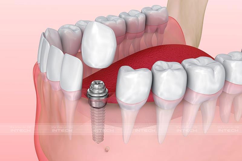 Phương pháp trồng răng Implant