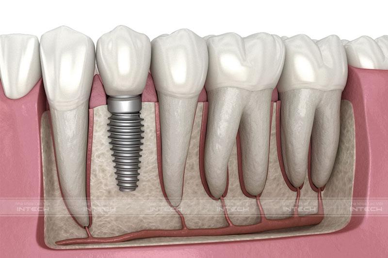 Phương pháp trồng răng Implant