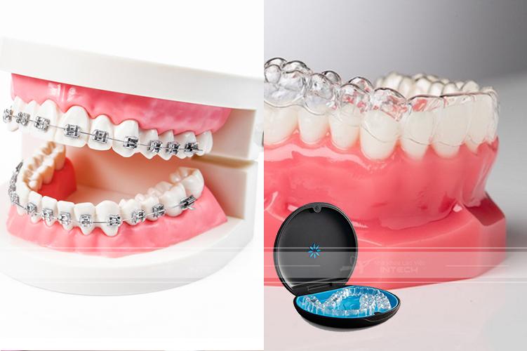 Chọn phương pháp niềng răng phù hợp để không giảm cân khi niềng