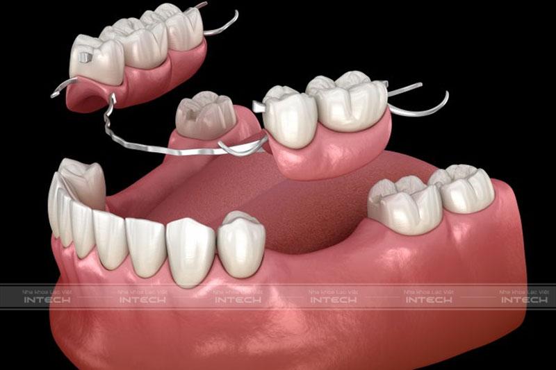 Phương pháp răng giả tháo lắp