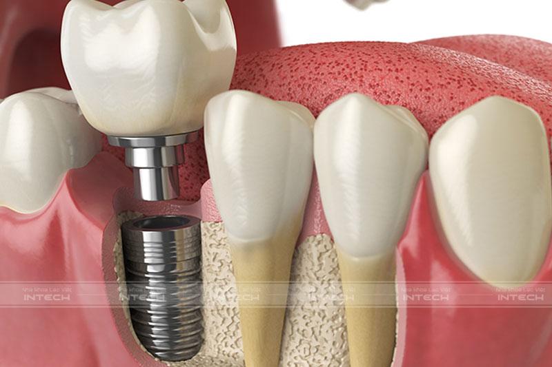 Phương pháp trồng răng Implant đem đến rất nhiều ưu điểm vượt trội