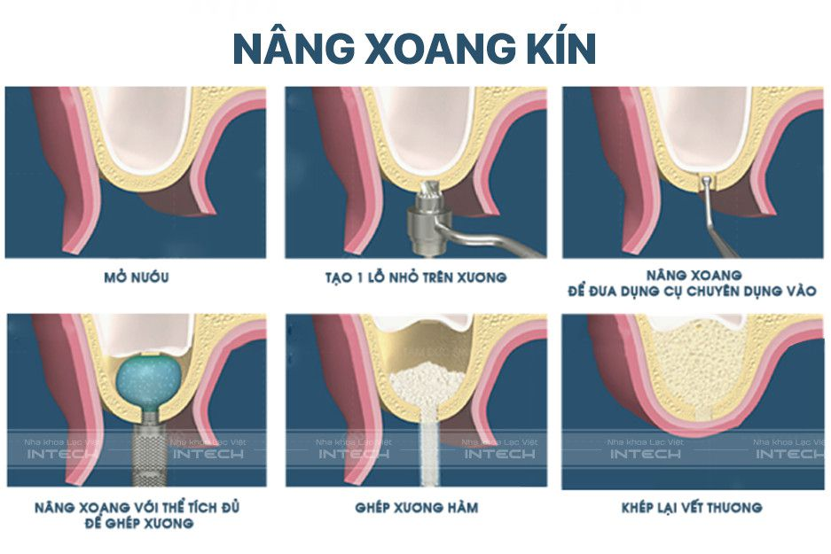 Quy trình thực hiện nâng xoang kín 