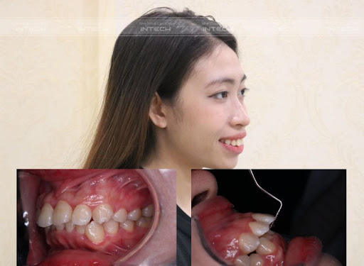 hình ảnh răng hô nặng