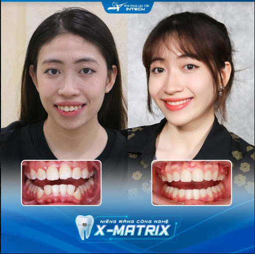 răng hô nặng có niềng được không