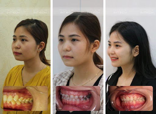 răng hô nhẹ
