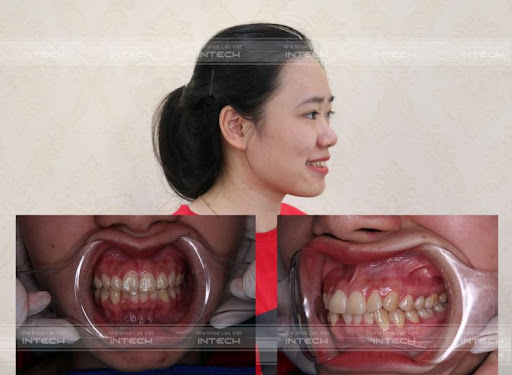 răng hơi hô phải làm sao