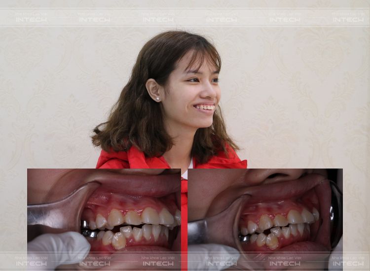 hình ảnh răng vẩu