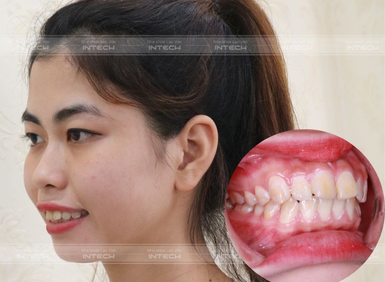 răng vổ