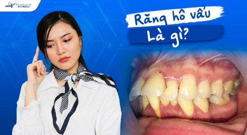 Răng hô vẩu là gì? Cách nhận biết và khắc phục hàm răng hô