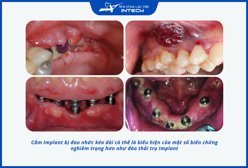 Răng Implant bị đau nhức kéo dài có thể là dấu hiệu của tình trạng đào thải trụ Implant