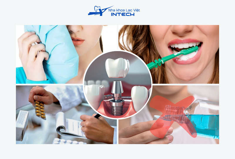 Cô chú/anh chị cần tuân thủ các chỉ định của bác sĩ sau cấy ghép Implant để đảm bảo Implant tích hợp thành công