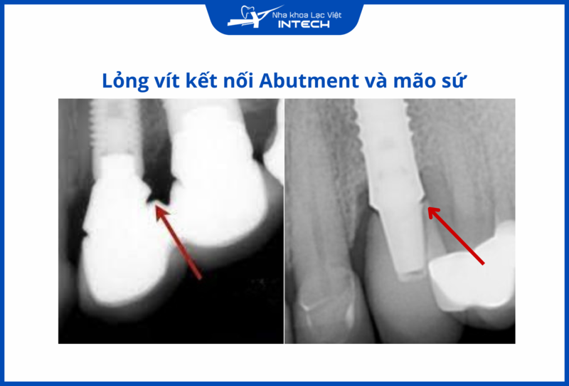 Lỏng kết nối giữa trụ phục hình và mão sứ cũng là nguyên nhân khiến răng Implant bị lung lay