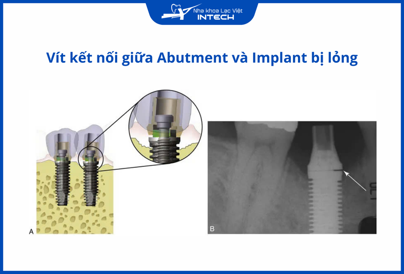 Lỏng vít kết nối giữa abutment và trụ Implant gây suy giảm chức năng ăn nhai