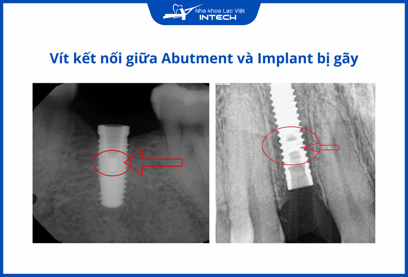 Tình trạng răng Implant bị lung lay do gãy vít nối Abutment và Implant có thể dẫn đến tháo bỏ và thay trụ mới