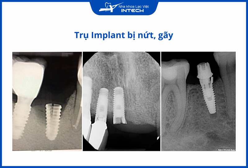 Trụ Implant bị gãy gây ra nhiều biến chứng nghiêm trọng, cô chú/anh chị cần đến nha khoa ngay lập tức