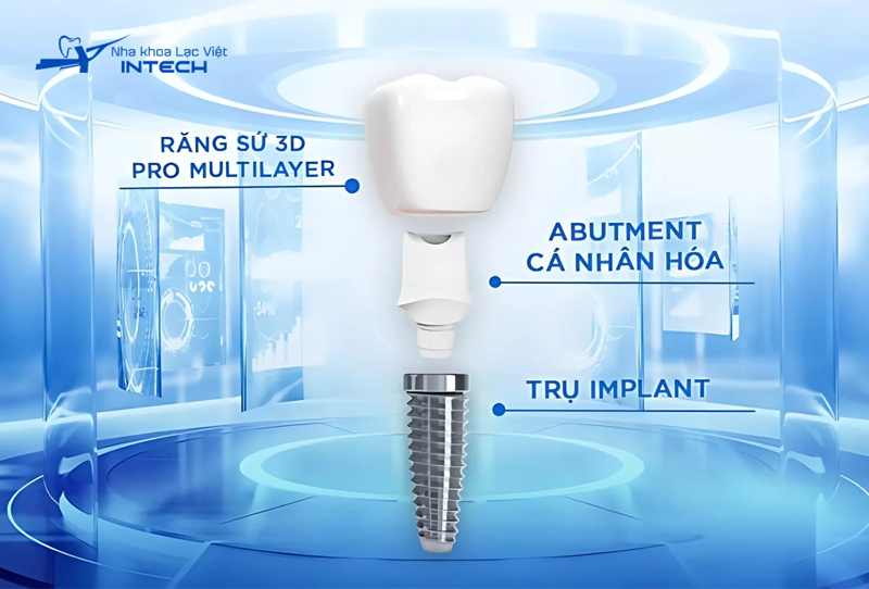 Răng Implant muốn bền vững cần đảm bảo chất lượng của cả 3 bộ phận bao gồm mão răng sứ, trụ phục hình và trụ Implant