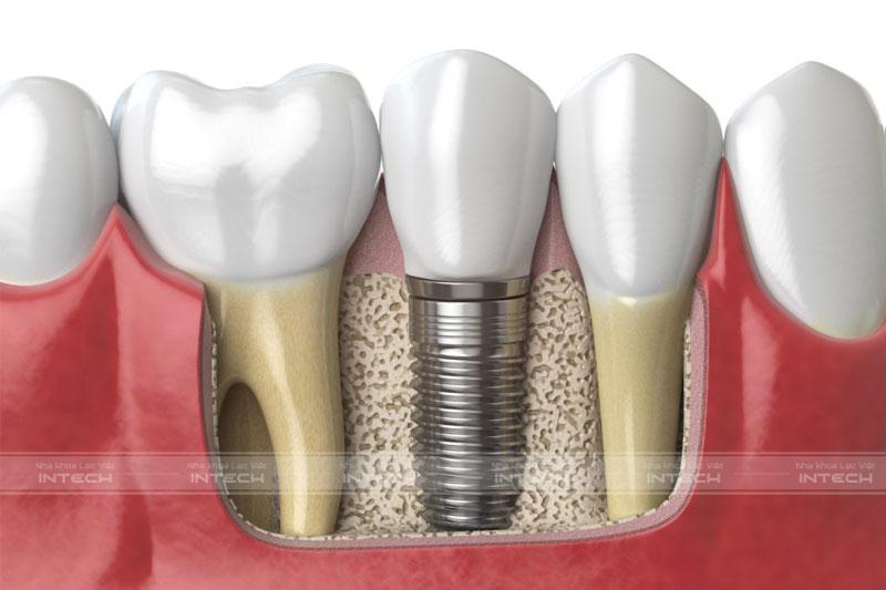 Răng Implant sau khi cấy sẽ tích hợp ổn định, chắc chắn với xương hàm