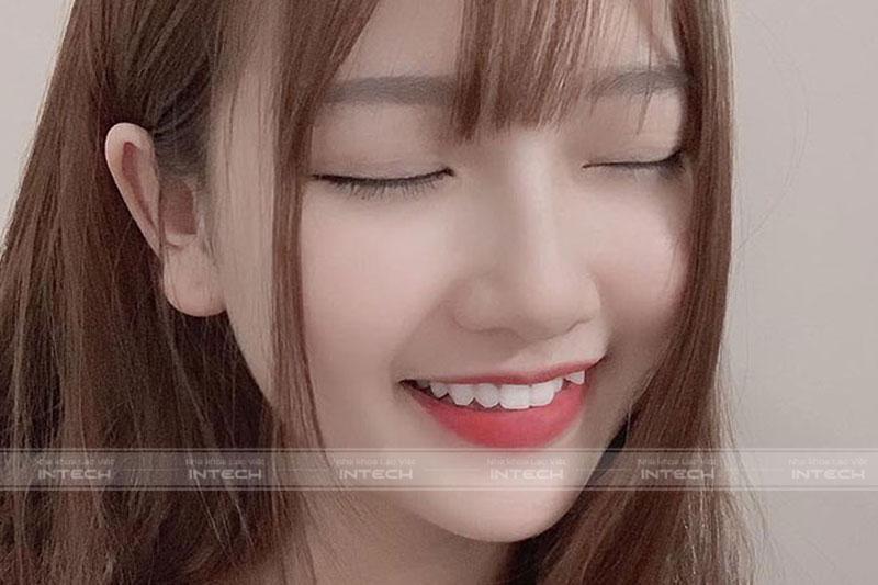 Răng khểnh có thể trồng được, tuy nhiên cần cân nhắc thật kỹ trước khi thực hiện
