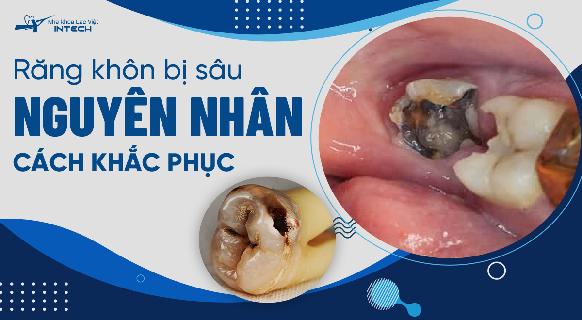 Răng khôn bị sâu: Nguyên nhân - Biến chứng - Cách xử lý