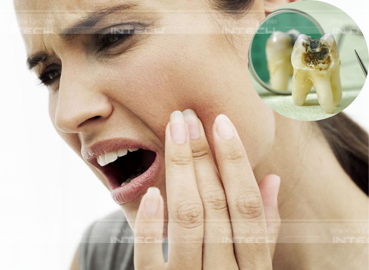 Răng khôn bị sâu gây đau nhức, khó chịu